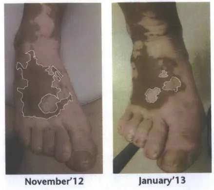 Figure 1-5: [9] fails to determine the right region when the lesion boundary is not well defined.