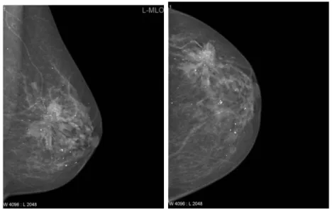 Figure 2-1: Two routine projects of mammograms: MLO (left) and CC (right).