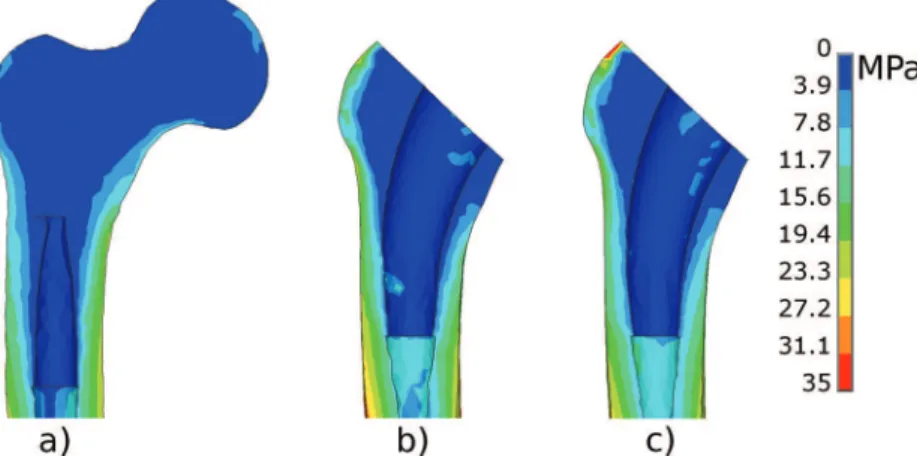 Fig. 8 Von Mises stress in the proximal femur for 1 km/h walk loading, completely osseointe- osseointe-grated implants (K n = 2000 N/mm, m s = 0.4, K t = 1000 N/mm, b = 15 MPa): (a) healthy femur;