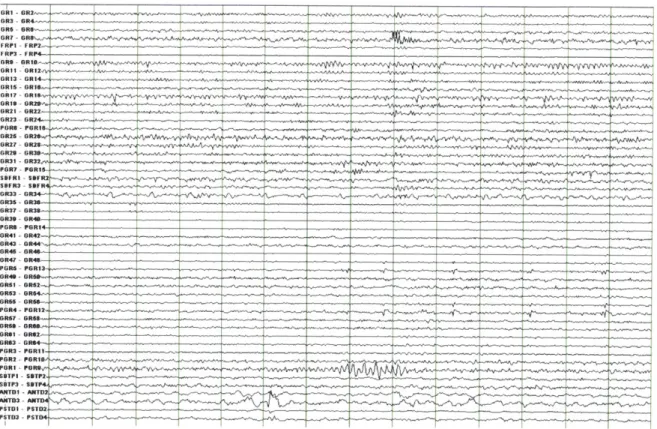 Figure 1-1.  A  14-second  window  of intracranial  EEG  during an  inter-ictal  (i.e