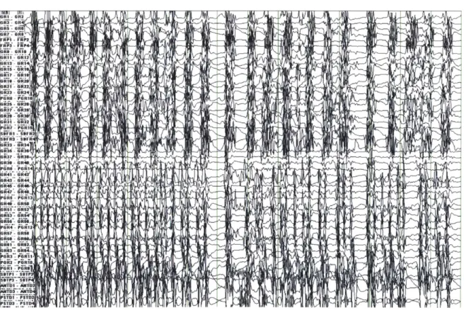 Figure 1-2.  A  14-second  window  of  intracranial EEG  during a  seizure