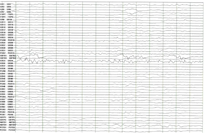 Figure  1-3.  A  14-second  window  of  intracranial  EEG  during  a  post-ictal  period,  beginning  less than  90  seconds  after  the  expert-marked  electrographic  end  of  a  seizure.