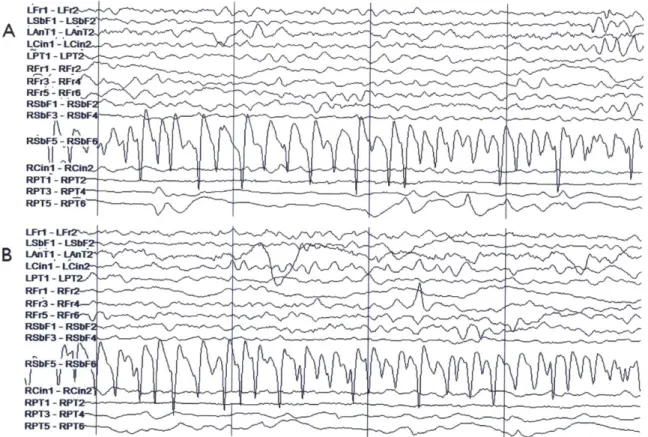 Figure  2-5.  Patient  7  intracranial  EEG  on  a  subset  of electrodes  in  two  epochs  showing  similar activity,  particularly  on  the  right  subfrontal  channel  'RSbF  5  - RSbF  6'