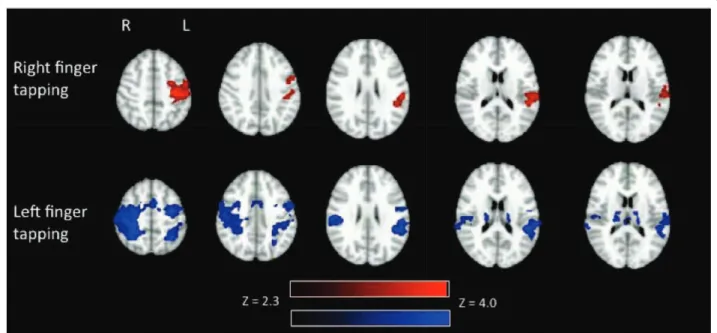 Figure 3 Group activation (N = 10) in white and gray matter during right finger tapping (above) and left finger tapping (below).