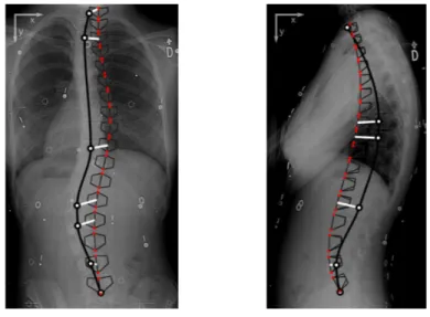 Figure 4: Using the location of the control points of the splines to improve fitting: since users place each control point over a vertebra, the location of the control point on the radiograph is used to attract the nearest vertebra of the AM
