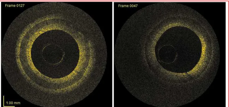 Fig. 2: Images taken from a pullback in a multilayer PVA-C phantom. The left image shows very  good contrast, but in the right image, the contrast between the first and second layer is different, and 