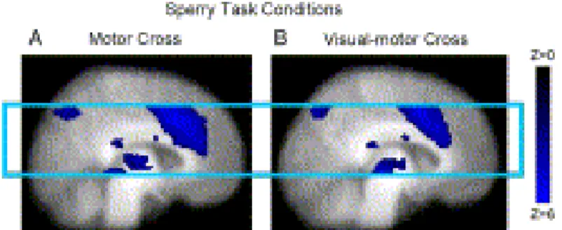 Fig. 3. Sperry task group activation showing similar clusters in both motor cross (A) and visual-motor cross  (B) conditions
