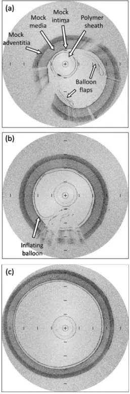FIG. 11. 共Color online兲 3D rendering of the balloon, obtained from a pull- pull-back at a pressure of 4 atm 共enhanced online兲