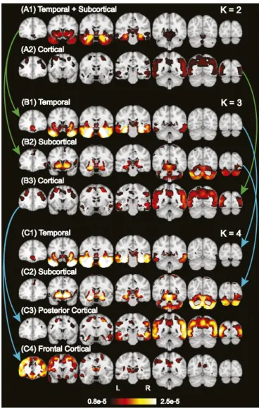 Fig. 2. Hierarchy of latent atrophy factors with distinct atrophy patterns in AD.