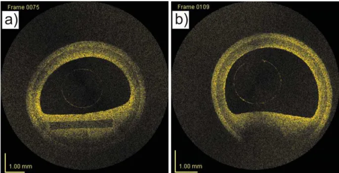 Figure 4. OCT images of an artery with (a) a calcification and (b) a lipid pool.