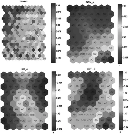 Figure 5.14 SOM Toolbox clustering of lung cancer samples using gene expression data for three representative genes measured by Bhatterjee et al