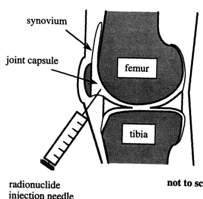 Figure  2-3: In radiation  synovectomy, a beta-emitting  radionuclide is into  the  joint  capsule  in  order  to  kill rheumatoid  synovium.
