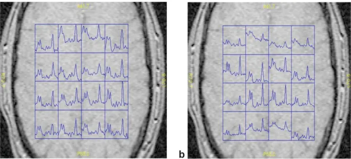 FIG. 8. In vivo spectra from the back axial slice of the 8 ⫻ 8 ⫻ 2 WE-SI (A) and CSI (B) data on the top of the gradient echo  localiza-tion brain image