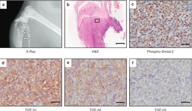 Figure 1 Transforming growth factor (TGF)-b1 is the predominant isoform expressed in MDA-MB-231-derived osteolytic lesions in the bone