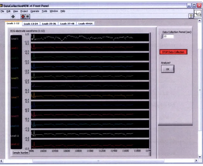 Figure 5.4:  Signal  Quality  Interface  for the acquisition of paced/VT data