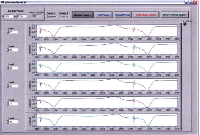 Figure  5.9: Correct  Cursor  Positioning  for selection  of one cardiac  cycle for  dipole analysis To  close  the  VT  Segment  Selection  Window  and  save  these  selections,  the  user  presses 'Final  Values  Chosen'