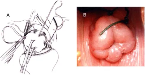 Figure  1-9:  Transvaginal  cerclage.  (A)  Schematic  of  the  procedure.  Modified  from  &#34;Netter Anatomy&#34;