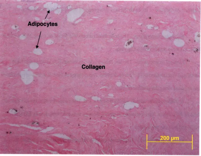 Figure 2.4:  Dermis  from propeller scar.  Within  the  superficial  dermis, there  is deposition of abundant  mature  collagen  with few  entrapped  adipocytes