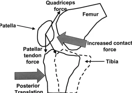 Figure 2.12.  A figure  demonstrating the effects  of posterior tibial translation  on contact  pressures  in  the  patellofemoral  joint