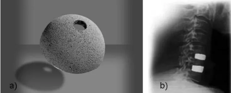 Fig. 5. Porous titanium coating on an acetabular cup for hip replacement (Courtesy of National Research Council Canada, Industrial Materials Institute) and b) porous  Niti-nol for cervical vertebra fusion (Courtesy of Biorthex).