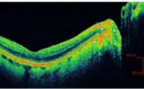 Figure 1. Example of retinal pigment epithelium (RPE) disruption in peripapillary atrophy in an eye with age-related macular degeneration (ARMD)