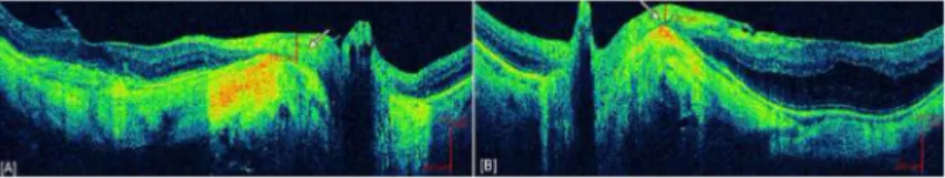 Figure 2. Example of retinal nerve fiber layer plaques