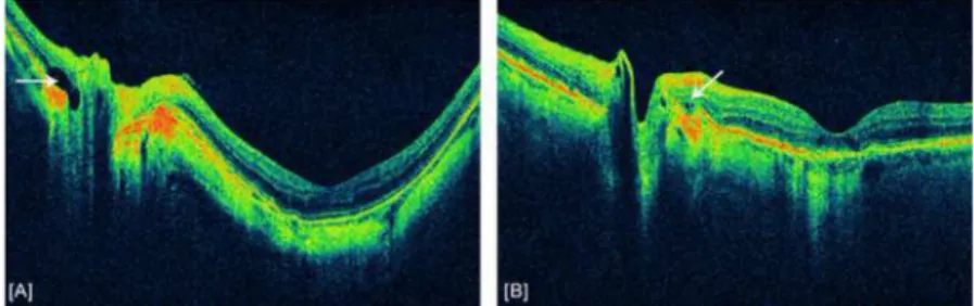 Figure 3. Example of intraretinal cystic changes