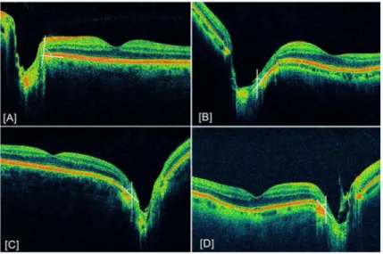 Figure 4. Example of abnormal retinal sloping