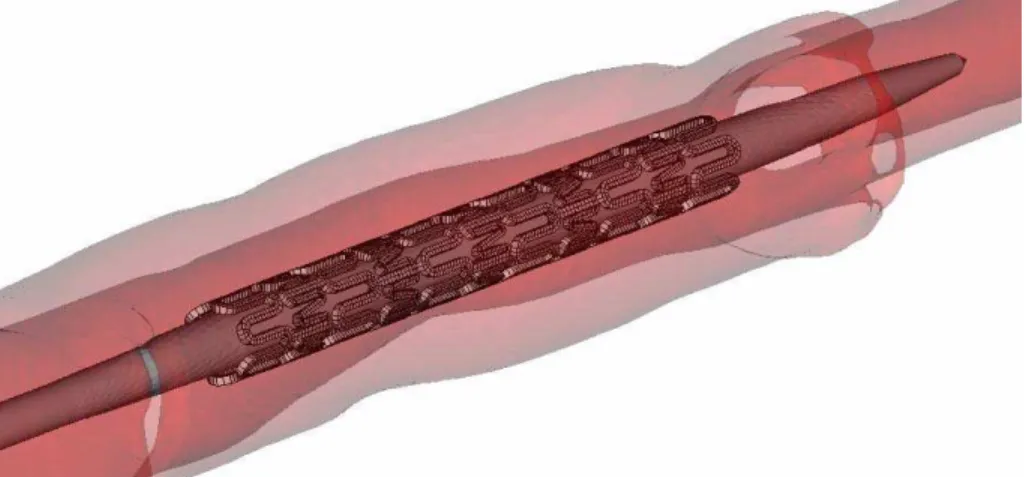 Figure 1 shows the balloon/stent model into the artery. 