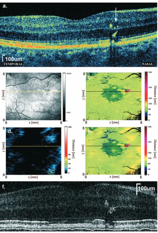 Fig. 11 Analysis of SOCT data for the macular region of the fellow 共 right 兲 eye of a patient suffering from idiopathic cystoid macular edema 共 a 兲 High-quality cross-sectional SOCT image 共3,000 A-scans兲, white arrow indicates pigment deposits and 共b兲 SOCT