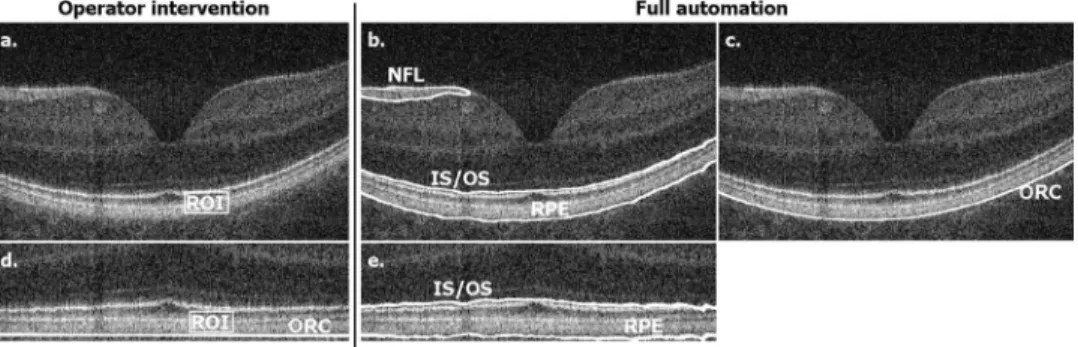 Fig. 5 Illustration of the procedure of segmentation of the posterior retinal layers including RPE and IS/OS junction