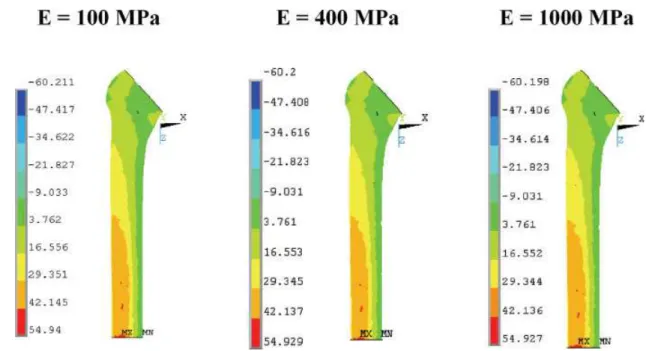 Figure 10. Effect of core stiffness on the maximum principal stress (MPa) in the femoral bone (cortical and cancellous) due to load case 2 and using ply conﬁguration I