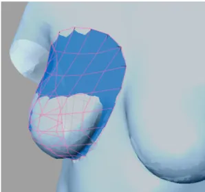 Figure 8. FDM-simulated unsupported breast compared to example scan.