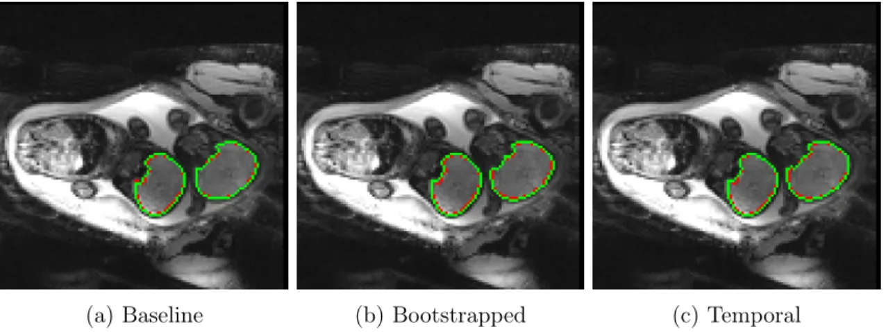 Figure 4-1: Segmentation predictions generated by each of the three models. Pre- Pre-dictions are illustrated in green, while the ground truth segmentation is shown in red.