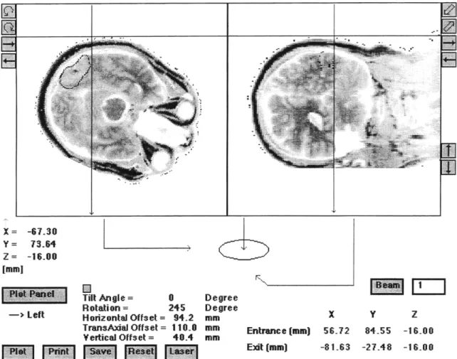 Figure 2.8  MacNCTPlan  Screen  Capture of Beam  Positioning