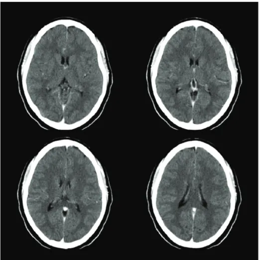 Figure 1.  Four views of a tomographic image of the brain.  The  intensity is related to the density