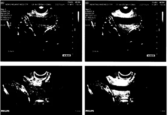 Figure  1.2:  Ultrasound images captured with and without gel-filled probe cover. 9