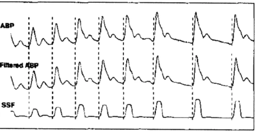 Figure  2-6:  Beat  extraction  based  on  wabp.  The  SSF  function  amplifies  the  rising portion  of  each  beat