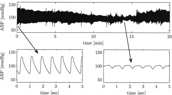 Figure  3-1:  Damped  ABP waveform.  Top  plot  shows  a  20  minute  ABP waveform.  Bottom- Bottom-left  plot  is  a  zoom-in  near  the  earlier  part,  and  bottom-right  plot  is  a  zoom-in  around  the 14th  minute