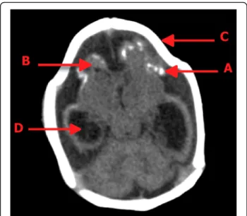 Fig. 1 a Intracebral calcifications of the congenital prenatal infectious type. b Cerebral hypoplasia