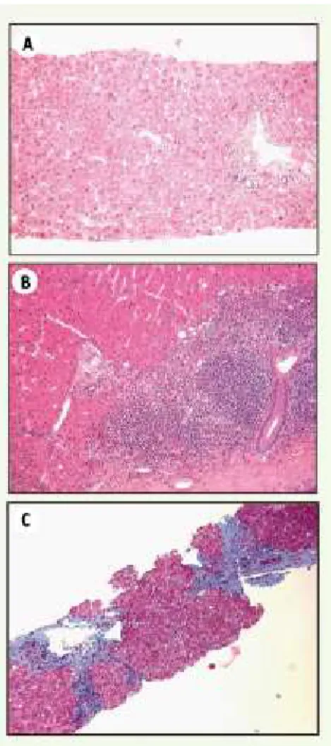 Figure 2. Évolution rapide vers la cirrhose. A. Hépatite aiguë. B. Hépatite chronique.C
