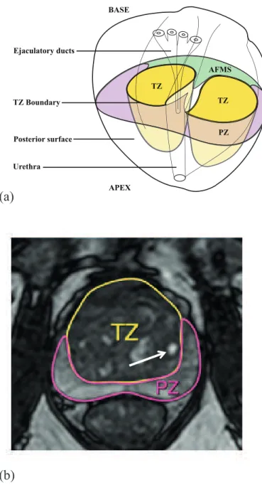 Figure 1: anatomic description (a) and T2-weighted MRI (b) of an average 60cc prostate showing its zonal anatomy with a transverse section at the verumontanum level (TZ: