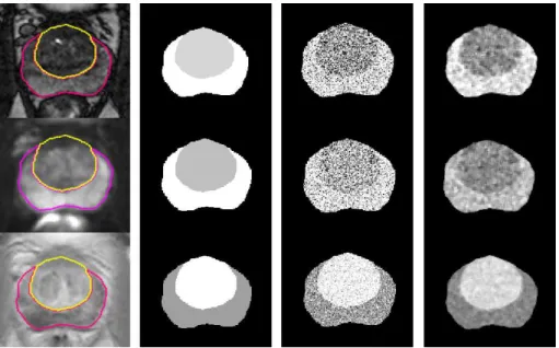 Figure 4: Image simulation process. From Left to right : original MRI with pre-delineated PZ and TZ, PZ and TZ labelled with their respective mean level, data with Gaussian noise, data after a smoothing median filter