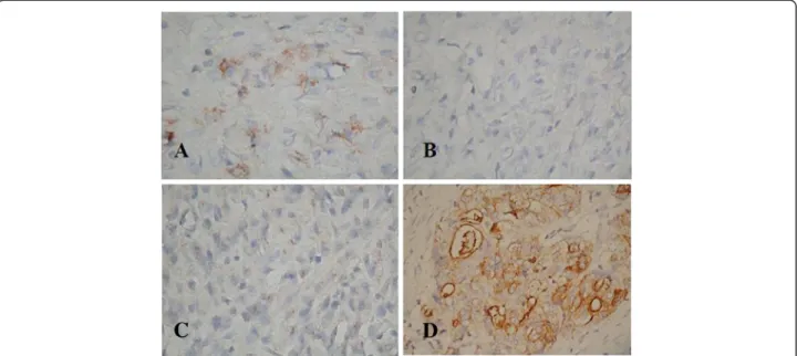 Figure 1 Immunohistochemical staining of C44/CD24 protein expression in recurrent gastric cancer tissue (400x)