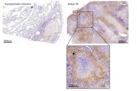Fig. S1 Immuno-histological analysis of DCIR expression in the lungs of M. tuberculosis- tuberculosis-infected non-human primates (macaques) during asymptomatic infection (left panel) or active  TB disease (right panels).