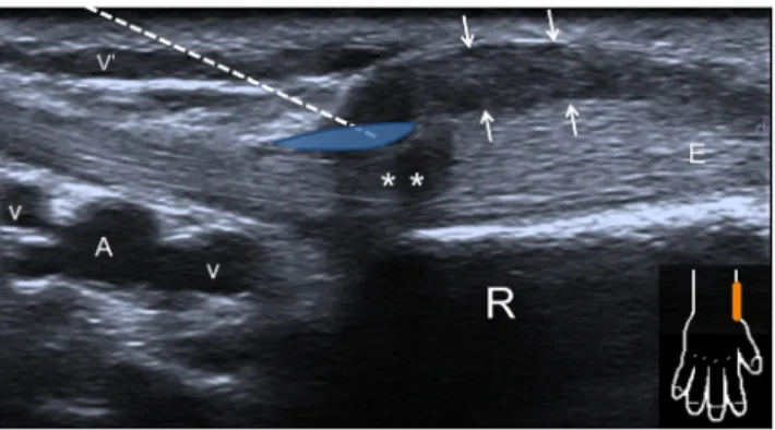 Fig. 3 Photograph of a US guided release for de Quervain's tenosynovitis (simulation)