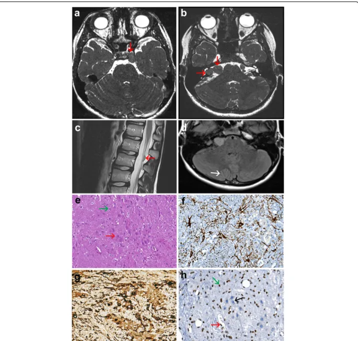 Fig. 1 Imaging characteristics of the brain and spinal lesions; pathological hallmarks of the spinal lesion