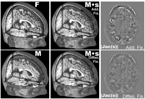 Figure 7: Registration of two synthetic T1 MR images of distinct anatomies. The focus is on the evaluation of our proposed update rule (diffeomorphic) with the most popular one (additive)