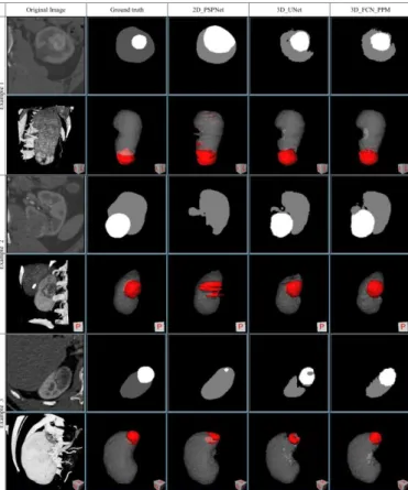Fig.   5 The  image  with   the  lowest  dice   coefficient  of   tumor   region  in   the testing dataset