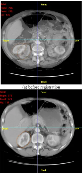 Fig 3: Kidney-centered registration result. 